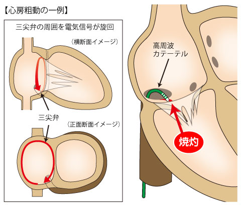 不整脈検査・治療 | 東京慈恵会医科大学附属病院 循環器内科