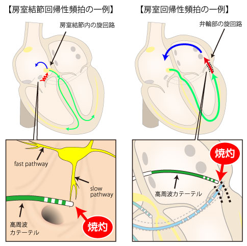 不整脈検査・治療 | 東京慈恵会医科大学附属病院 循環器内科